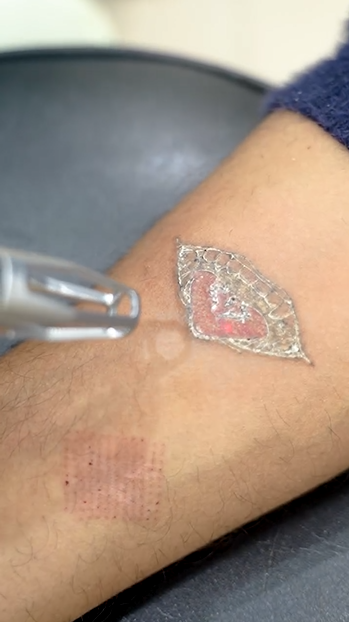 Tattoo Removal